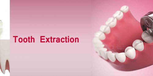 tooth-extraction-slide