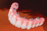 services-ic-inclusive-screw-retained-hybrid-denture