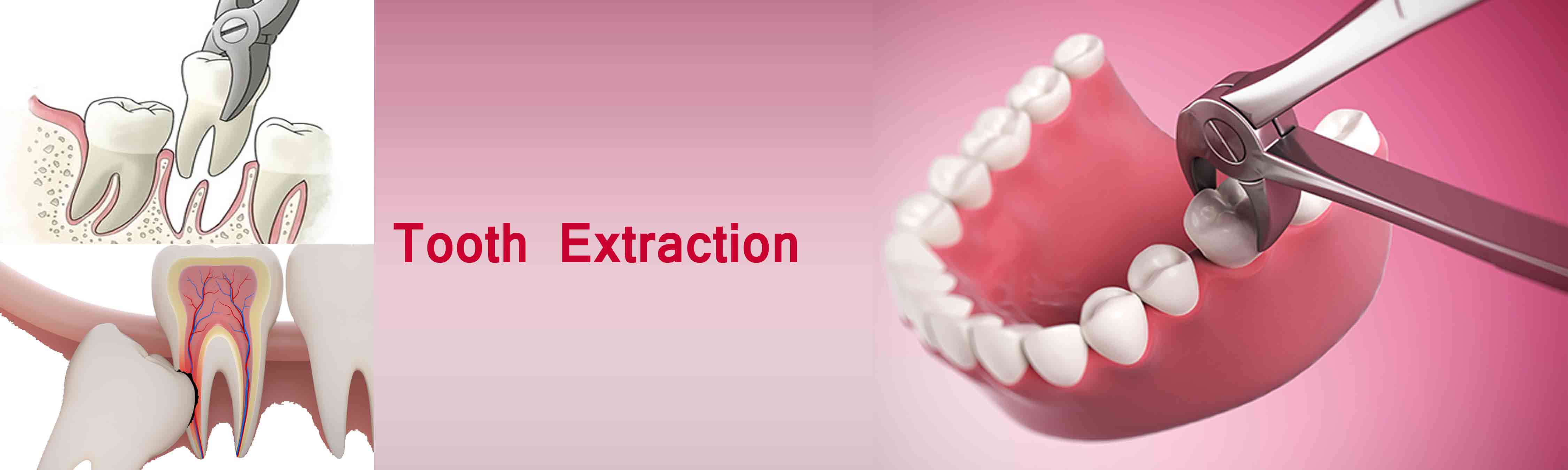 Tooth extraction. Зуб абстракция. Зубной фон.