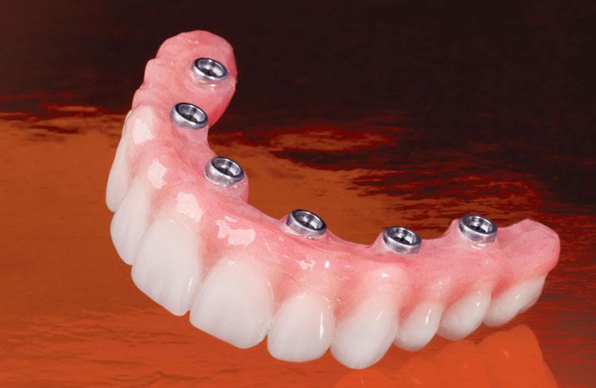 services-ic-inclusive-screw-retained-hybrid-denture
